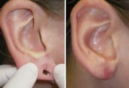EAR LOBE REPAIR AND DERMATOSURGERIES