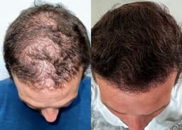 HAIR RESTORATION