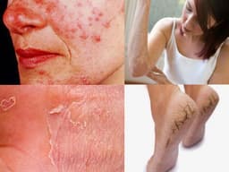 SKIN CONCERNS